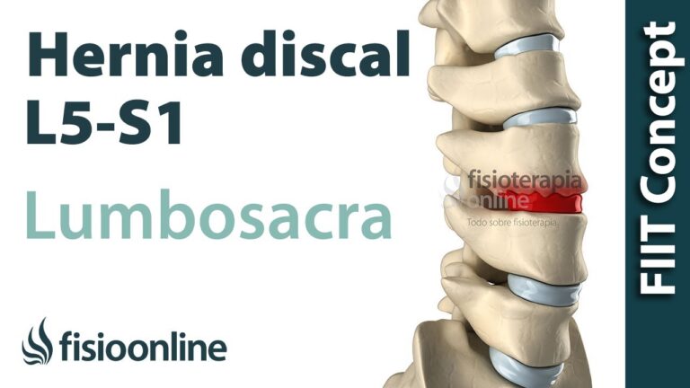 Descubre todo sobre la hernia discal: CIE 10 y tratamientos